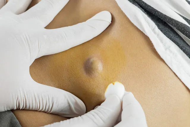 Chirurgie d’exérèse du kyste