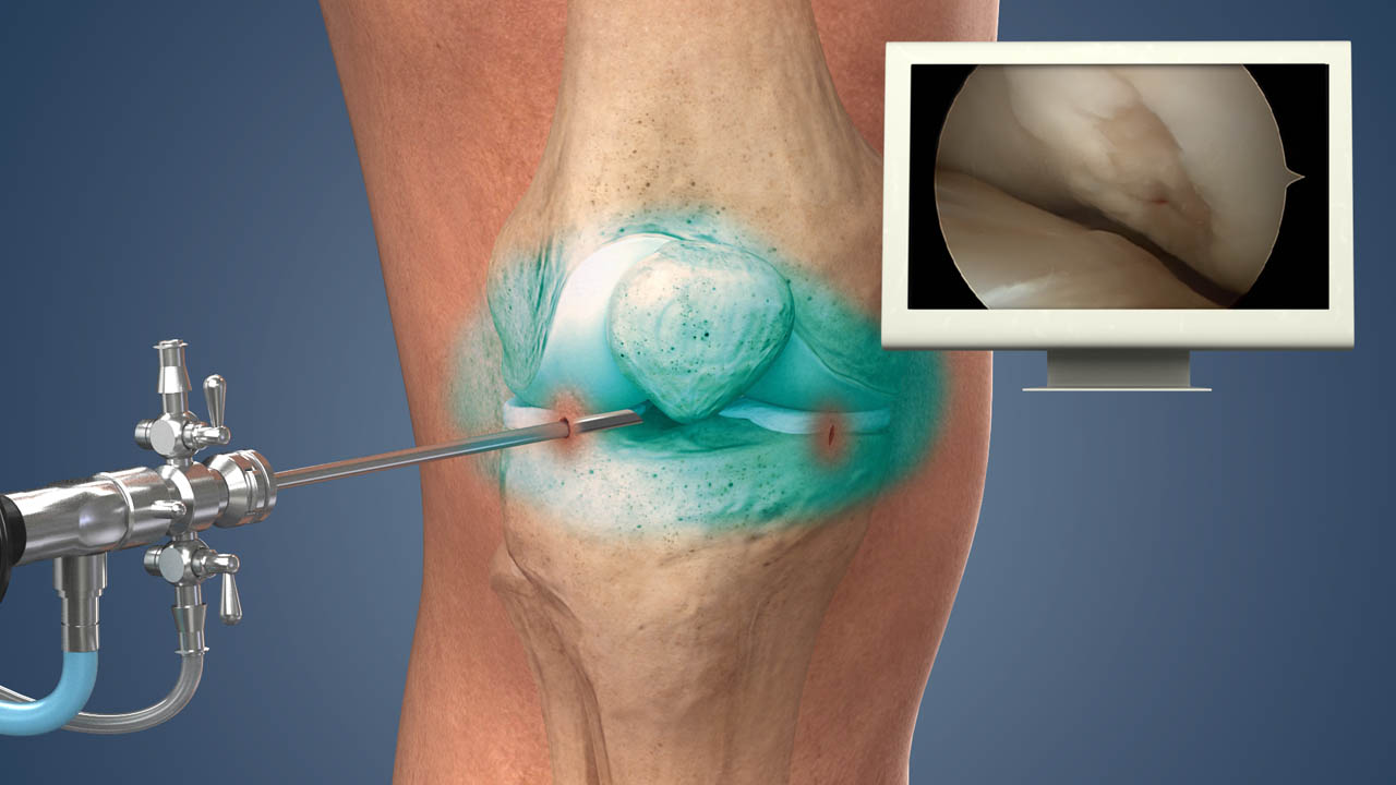 Knee Arthroscopy