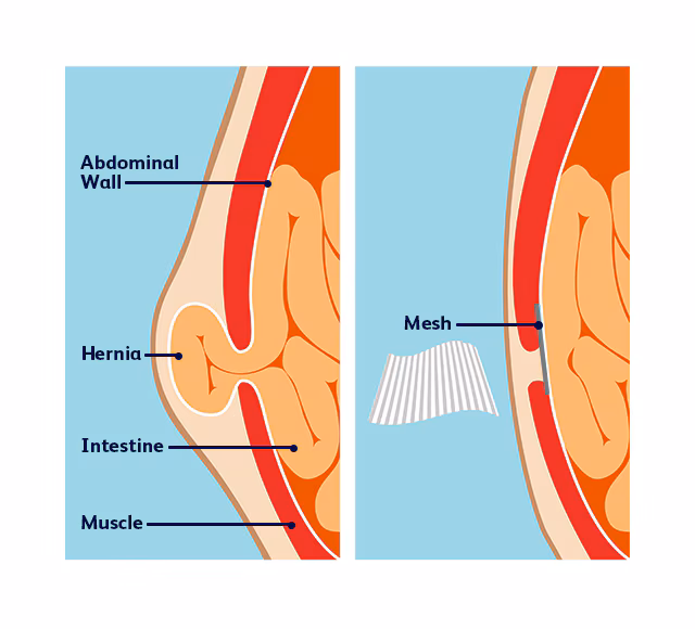 Chirurgie de la hernie ombilicale