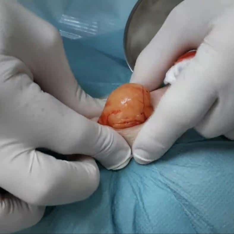 Chirurgie d’exérèse du lipome