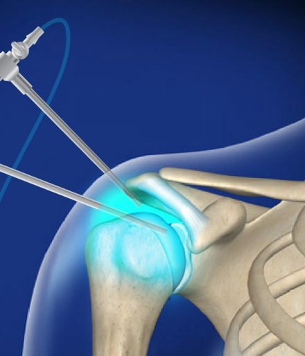 Arthroscopie de l’épaule