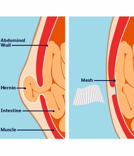 Inguinal Hernia Surgery